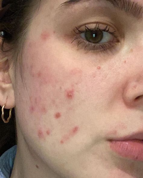 Diana’s Instagram profile post: “Anyone else having even more breakouts due to face masks? Need to try and find better materials😭 #acne #maskcne #maskne #spots #breakout…” Acne Insecurities, Breakouts On Face, Growing Confidence, Skin Positivity, Regular Skin Care Routine, Marks Cream, Celebrity Skin Care, Scar Removal Cream, Girlfriend Aesthetic