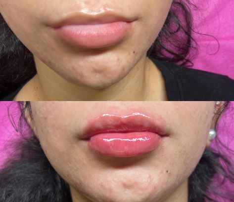 Before and after 1mL of Needless Lip Plumping! 🫦 Needless lip plumping ( noninvasive ) The goal is to have nice plump and HYDRATED lips without having to use needles during the procedure. ♡30-45 minute procedure ♡Painless ♡Enhances natural lip shape ♡7 day healing process ♡Minimal to zero bruising ♡3 to 5 sessions to get desired look ♡Lasts up to 6-14 months Instant results Lash and lip combo packages also available Hey!! I’m Thai! A two timed certified lash technician and LICEN... Cosmetic Treatments, Upper Lip, Lip Shapes, Cosmetic Procedures, Lip Hydration, Healing Process, Natural Lips, Outfit Inspiration Fall, Lashes