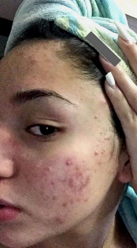 Acne Positive, Beautiful Acne, Teenage Acne, Lotion For Oily Skin, Acne Overnight, Natural Acne Remedies, Severe Acne, How To Get Rid Of Pimples, Acne Remedies