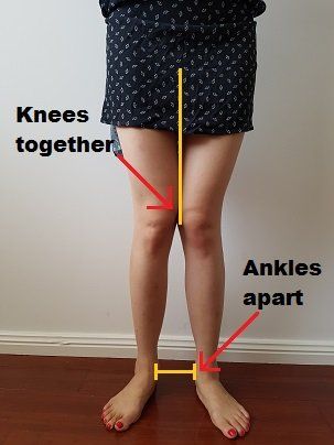 Knock Knees Exercises, Knee Valgus, Flat Feet Exercises, Knock Knees Correction, Genu Valgum, Knock Knees, Hip Problems, Foot Exercises, Posture Exercises