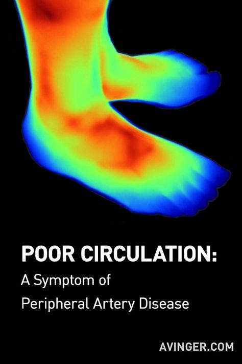 Your body’s cardiovascular system moves the life-supporting blood throughout your body. It allows your heart to beat, your body to move, and your brain to process. When this natural blood flow isn’t working properly, it can lead to symptoms that initially appear in the feet and legs.  These symptoms are driven by Peripheral Artery Disease or PAD. Peripheral Artery, Hungry All The Time, Nerve Health, High Blood Sugar Levels, Poor Circulation, Health Magazine, Nerve Pain, Good Health Tips, How To Stay Awake