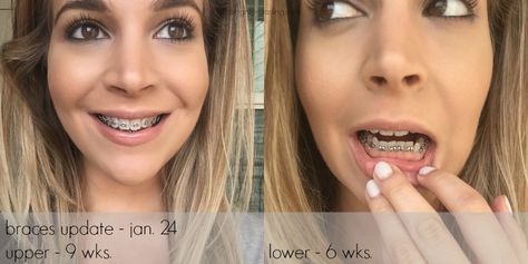 My adult braces journey at 30 years old, here's my 9 week update and progress pictures on brighterdarling.com Before And After Braces Pictures, Braces Progress, Braces Advice, Braces Journey, Braces Before And After, After Braces, Adult Braces, Getting Braces