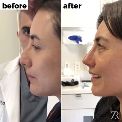 Nonsurgical rhinoplasty is like the magic I never knew existed. Here is my experience with getting a nose job and why you should try it! Nonsurgical Nose Job Before And After, Non Surgical Nose Job Before After, Nose Injections Before And After, Filler Nose Job Before After, Botox Nose Before After, Botched Rhinoplasty, Liquid Nose Job Before And After, Alarplasty Before After, Nose Tip Surgery Before After