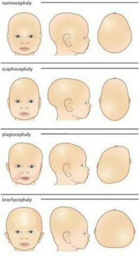 Different Head Shapes, Cranial Sacral Therapy, Pediatric Physical Therapy Activities, Orthotics And Prosthetics, Doc Band, Baby Helmet, Nclex Prep, Helmet Designs, Pediatric Physical Therapy