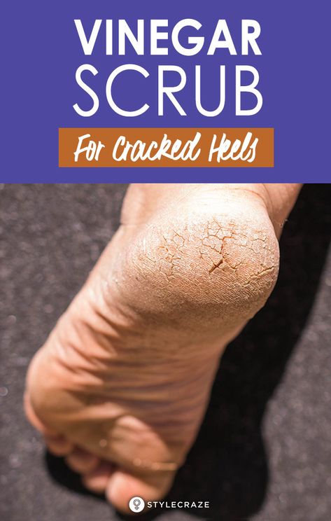 Cracked Heels Diy, Cracked Feet Remedies, Heel Scrub, Cracked Heel Remedies, Dry Cracked Heels, Dry Heels, Rough Heels, Cracked Heels, Cracked Skin