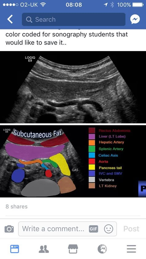 Diagnostic Medical Sonography Student, Ultrasound School, Ultrasound Physics, Cardiac Sonography, Ultra Sound, Sonography Student, Vascular Ultrasound, Medical Sonography, Ultrasound Sonography