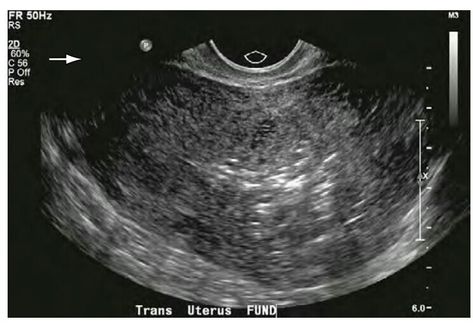 Transvaginal ultrasound of a normal uterus 5 days postpartum. Transverse image shows echogenic foci in the endometrial cavity, which may be a normal finding in a postpartum patient. Uterus Ultrasound, Cystic Ovaries, Ultrasound Pictures, Bts V Pictures, Chroma Key, Ultrasound, Education, Bts, Quick Saves