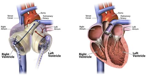 Artificial Heart, Donate Life, New Heart, Human Heart, Ronald Reagan, Cardiology, Medical Science, Heart Design, Disease