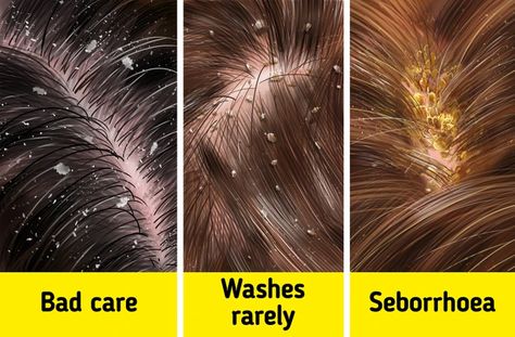 What Causes Dandruff, and How to Treat It / 5-Minute Crafts What Causes Dandruff, Shampoo For Dry Scalp, Getting Rid Of Dandruff, Fun Facts About Life, Anti Dandruff Shampoo, Itchy Scalp, Flaky Skin, Anti Dandruff, Skin Diseases