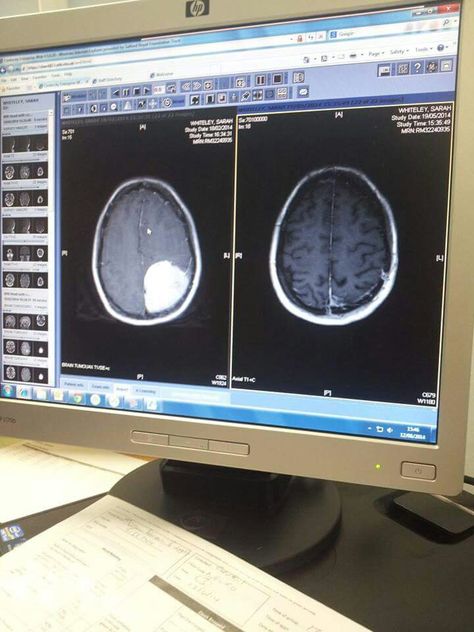 Before n after!!bye bye Tina Tumour!! Brain Tumour Fake Report, Brain Tumour, Bye Bye, X Ray, Study Motivation, Simple Nails, Brain, Nails, Quick Saves