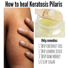 Have KP? Keratosis Pilaris occurs when hair follicles are blocked with built up keratin causing irritation redness bumpiness and sometimes small whiteheads. This shows up most commonly on the lower cheeks and upper arms. I found the BEST body scrub that has cleared up all of my KP. The coconut oil and honey soften and cleanse your skin while sugar sloughs the dead skin off. The lemon juice is also antibacterial! My skin has never looked better try it out! by diy.remedies Спонж Beauty Blender, Best Body Scrub, Strawberry Legs, Keratosis Pilaris, Coconut Oil Uses, Coconut Oil For Skin, Diy Remedies, Chicken Skin, Hair Follicles