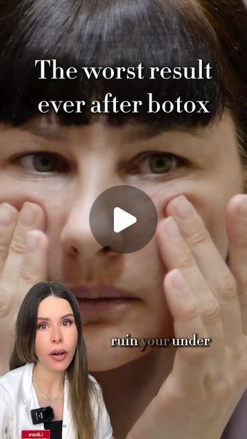 Dr Rebecka Gardell on Instagram: "Crows feet botox can in some people give a swollen under eye area. If that’s the case, place the botox injection points differently to avoid this." Botox Injection Points, Botox For Frown Lines, Botox Crows Feet Eye, Botox For Crows Feet Before And After, Botox For Hooded Eyes, Under Eye Botox Before And After, Botox Around Eyes, Crows Feet Botox Before After, Botox Under Eyes Before And After