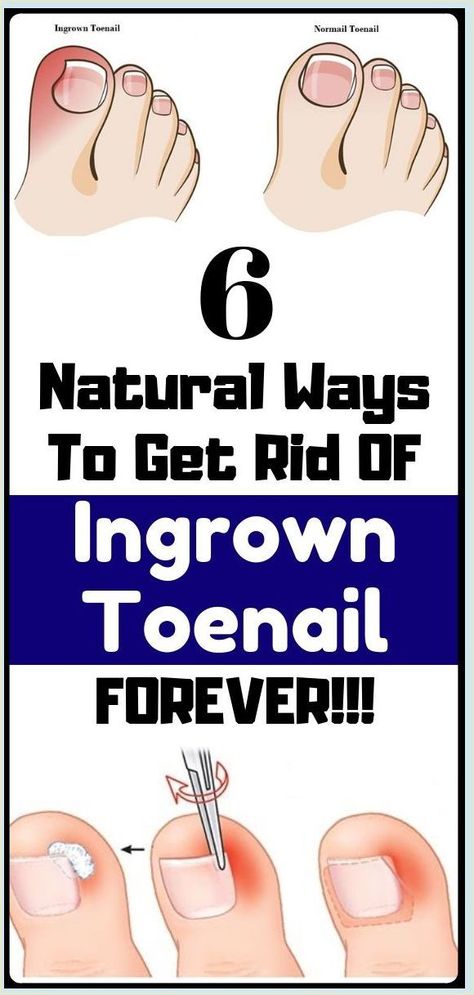 Foot Nail Problems Nail Fungus Remedy, Ingrown Toenail, Healing Remedies, Ingrown Nail, Tongue Health, Health Signs, Health Hacks, Healthy Advice, Ingrown Toe Nail