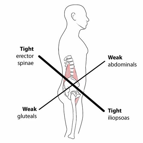 About Your Condition – Lower Crossed Syndrome   Your posture plays an important role in your overall health. Poor posture leads to chronic strain and discomfort. “Lower crossed syndrome” is poor posture that results from excessive tightness in your lower back and hip flexor muscles with weakness in your abdominal and buttock muscles. Patients with lower crossed syndrome often have a “sway back.”   Need help setting up an ergonomic workstation? Use this handy guide 👇  https://chiroup.com/wp-cont Lower Cross Syndrome, Ergonomic Workstation, Fascia Lata, Sway Back, Small Group Training, Rehabilitation Exercises, Musculoskeletal Pain, Gluteus Medius, Muscle Imbalance