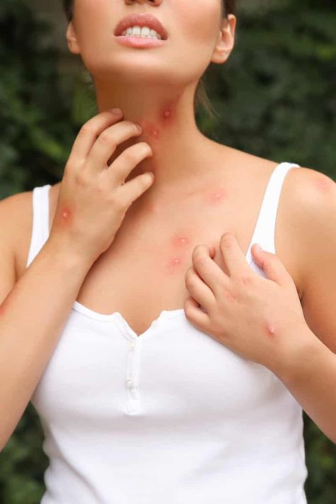 Certain people tend to get bitten by mosquitoes more than others. Check out how you can prevent mosquito bites #bites #mosquito #mosquitos #mosquitobites #preventbites #preventmosquitos Types Of Bug Bites, Prevent Mosquito Bites, Mosquito Traps, Bad Bugs, Bug Bite, Types Of Bugs, Pet Water Bowl, Kill Mosquitos, Fire Ants