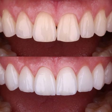 Dental Makeover, Pretty Teeth, Teeth Whitening Procedure, Homemade Toothpaste, Veneers Teeth, Teeth Whitening Remedies, Beautiful Teeth, Loose Tooth, Dental Design