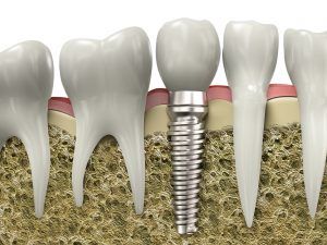 The dental implant timeline varies from one patient to another. It depends on the current condition and complexity of the dental issues of a patient. Dental Implant Procedure, Implant Dentist, Best Dental Implants, Dental Implant Surgery, Dental Implants Cost, Dental Bridge, Teeth Implants, Best Teeth Whitening, Dental Crowns