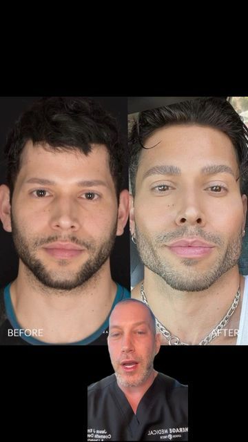 Jason Emer, MD on Instagram: "PICTURE PERFECT MALE FACIAL SCULPTING Our patient is a musical artist and wants to look his best while performing. He’s really craving a more chiseled jawline with pronounced cheeks. Using a combination of Bellafill and Radiesse filler, we’re going to enhance his already sculpted anatomy so that he looks contoured and natural. We are going to add structure to his jawline and give him a sharper, stronger look on his cheek bones. He got exactly what he was looking fo Chiseled Face Man, Mens Jawline Filler, Jawline Pictures, Chiseled Jawline Men, Hollow Cheeks Male, Cheek Bone Exercises, Male Jawline, Jawline Surgery, Prominent Jawline