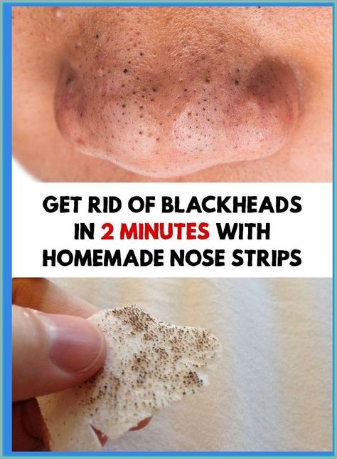 Get Rid of Blackheads For Good Homemade Nose Strips, Remove Blackheads From Nose, Maquillage Yeux Cut Crease, Blackheads On Nose, Black Heads, Rid Of Blackheads, Pore Strips, Easy Bun, Nose Strips