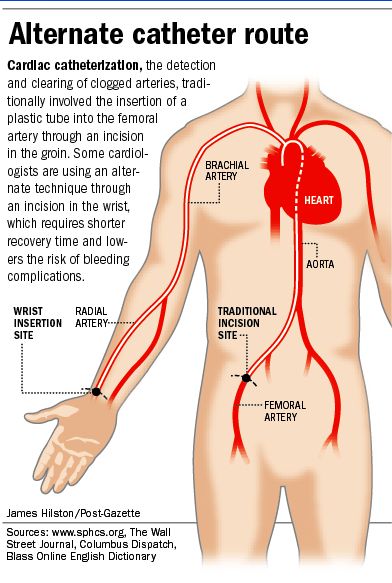 Cardiac catheterization