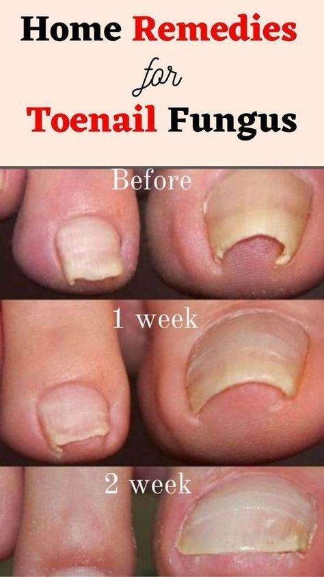 fungal nail treatment Toenail Health, Toenail Fungal Infection, Nail Remedies, Fingernail Fungus, Toenail Fungus Remedies, Nail Infection, Fungal Nail, Nails Today, Toenail Fungus