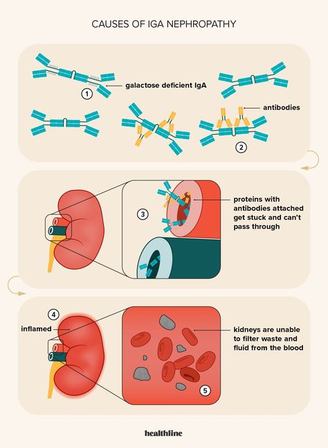 Iga Nephropathy, Blood Test Results, Medical Terminology, Website Services, Medical News, Medical Illustration, Blood Test, Medical Advice, Disease