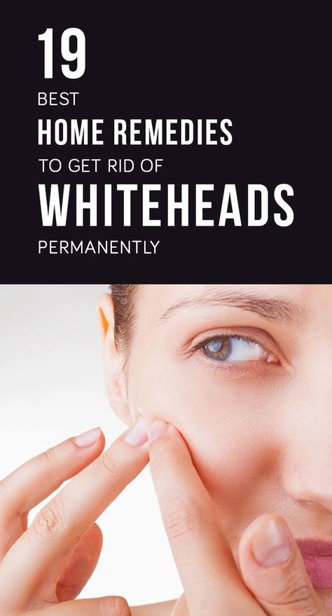 Do you want to get rid of these whiteheads ? Are you unhappy with this unhygienic way you look? Fight whiteheads successfully by following these remedies. Whiteheads Remedy, Warts On Face, Skin Care Routine For 20s, Fall Makeup Looks, Anti Aging Tips, Simple Skincare, How To Apply Makeup, Skin Care Regimen, Home Remedies