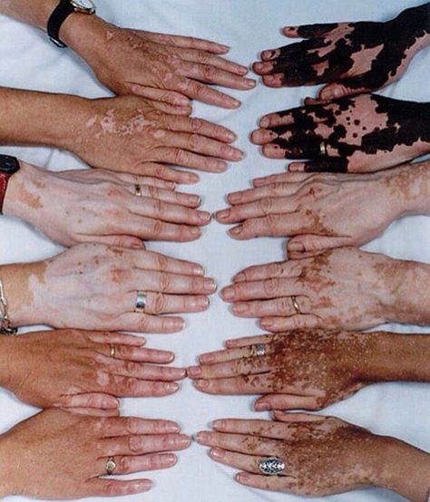 Vitiligo contrast hands Muzică Rock, Shooting Photo, Body Positivity, Character Inspiration, Photography Inspiration, Pretty People, Beautiful People, Body Art, Art Reference