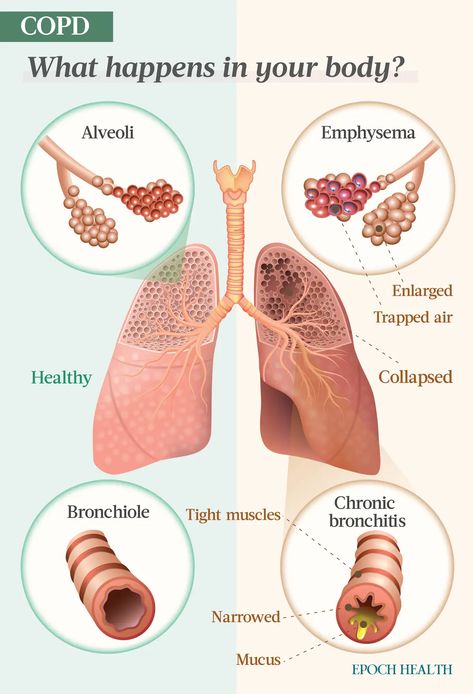 The Essential Guide to COPD: Symptoms, Causes, Treatments, and Natural Approaches | The Epoch Times Pathophysiology Notes, Chicken Francese Recipe, Anatomy Education, Chicken Francese, Healthy Lungs, Chronic Obstructive Pulmonary Disease, Respiratory Therapy, Nursing School Studying, Med Surg