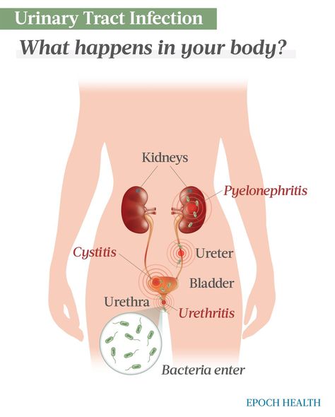 The Essential Guide to Urinary Tract Infections: Symptoms, Causes, Treatments, and Natural Approaches | The Epoch Times Remedies For Urinary Infection, Urinary Tract Infections Home Remedies, Urine Tract Infection, Bourdier Photoshoot, Herbs For Urinary Tract Infections, Urinary Tract Infections (utis), Frequent Urination, Uva Ursi, Kidney Damage