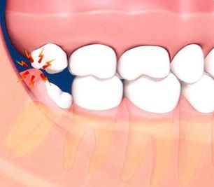 Exposure of Impacted Teeth | Teeth grow into the mouth by passing through the gums and emerging into their natural position. Sometimes, however, a tooth becomes “stuck” and either does not emerge or only partially emerges into the mouth. When this occurs, the tooth is said to be “impacted.” The most common impacted teeth are the wisdom teeth in the back of the mouth and the canines in the front of the mouth. Wisdom Teeth Pain Relief, Tooth Extraction Food, Tooth Extraction Aftercare, Wisdom Teeth Pain, Tooth Extraction Healing, Dental Medicine, Impacted Tooth, Dental Information, Dental Surgery Food