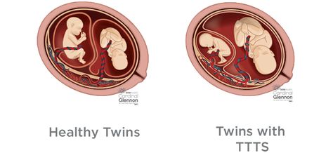 TTTS, twin to twin transfusion syndrome Twins In The Womb, Holistic Birth, Obstetrics Nursing, Pregnancy Eating, Sonography Student, Midwifery Student, Embryonic Development, Pregnancy Chalkboard, Diagnostic Medical Sonography