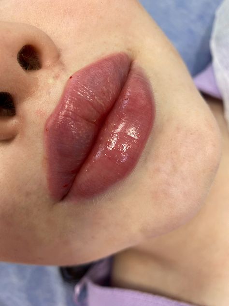 Lip Filler No Cupids Bow, Lip Filler Shape Ideas Korean, Lip Implants Before And After, Heart Shape Lips Fillers, Different Lip Filler Shapes, Bow Shaped Lips, Russian Lips Filler, Aesthetic Lips, Russian Lips