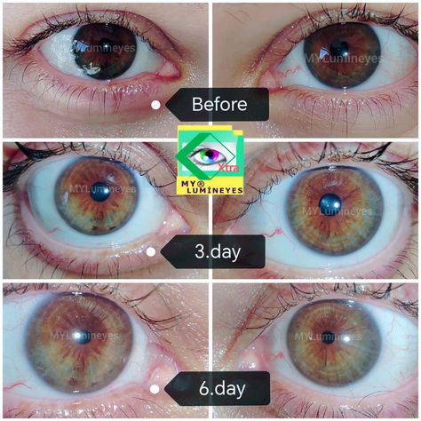 Grade 3-4 medium brown eyes, in 6 progression with Lumineyes xtra laser eye color change by Dr. Mustafa Mete. You can change your eye color naturally.. #lumineyes #lasereyecolorchange #lumineyesxtra #drmustafamete #eyecolorchangelaser #blueeyes #browneyes #browntoblue #eyecolorchangesurgery #eyecolors #eyecolorchange #changeyecolor #changingeyecolor More for change your eye color naturally : https://mylumineyes.com/how-to-change-eye-color-with-laser/ Manifest Eye Color, Eye Color Change Naturally, Subliminal Eye Color Change Results, How To Change Eye Color, Eye Color Subliminal Results, How To Change Your Eye Color, How To Change Eye Color Naturally, Changing Eye Color Naturally, Eye Subliminal