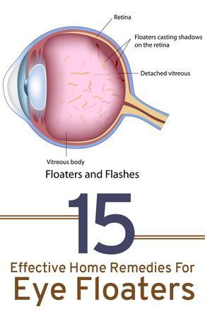 Eye Floaters Remedies Natural Treatments, Castor Oil For Eye Floaters, Eye Floaters Remedies, Floaters In The Eye, What Causes Eye Floaters, Eye Health Remedies, Eye Floaters Causes, Eyesight Improvement, Eye Floaters