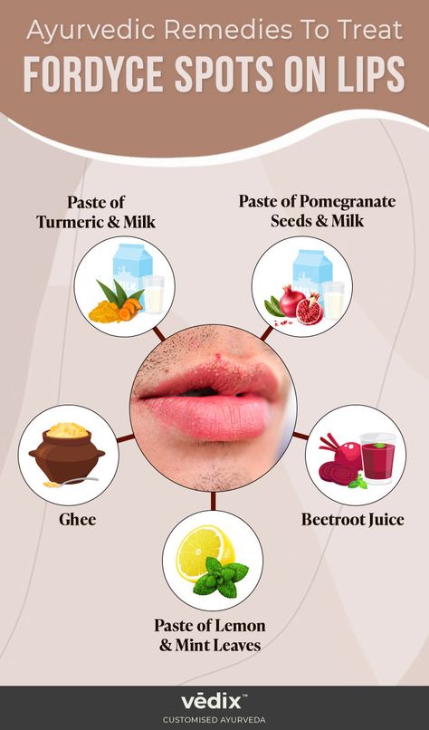 Fordyce Spots On Lips: How Does It Look? + Causes & Treatments – Vedix Fordyce Spots On Lips, Ayurvedic Tips, Turmeric Milk, Dental Cavities, Dark Spirit, Ayurvedic Remedies, Decorating Videos, Homemade Beauty, Cold Remedies