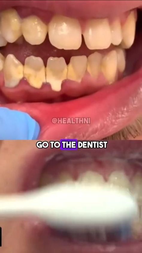 NATURAL RECIPE TO WHITTEN YOUR TEETH Tatoo 3d, Beginner Skin Care Routine, Teeth Whitening Homemade, Teeth Whitening Diy, Face Skin Care Routine, Diy Skin Care Routine, Teeth Health, Quick Workout Routine, Basic Skin Care Routine