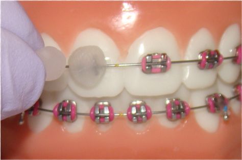 Compraste cera una y otra vez para cubrir tu pobre boca del estúpido y violento metal. Si hiciste aunque sea 10 de estas 24 cosas, sin duda usaste brackets Black Braces Teeth, Palate Expander, Braces Colours, Braces Journey, Braces Ideas, Double Jaw Surgery, Braces Pain, Braces Cost, Teeth Aesthetic