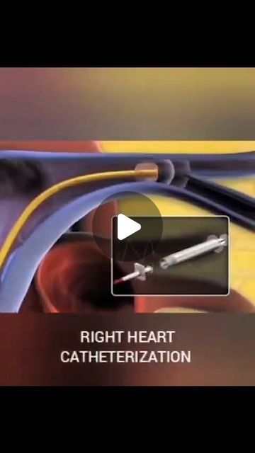 CardioVisual: Powered By MedicalVisual on Instagram: "Right heart catheterization animation  In this clip the Swan-Ganz catheter starts in the right atrium>right ventricle>pulmonary artery >pulmonary capillary wedge pressure  There are a multitude of things you can diagnostically do with a right heart cath. Things like basic pressures, valve studies, shunts, and cardiac output.  Which valve would we be assessing if we did a simultaneous pressure of the PCWP and LVEDP? 👇  .  .  .  .  .  Source @cardiovascularhc  #heart #cardiac #cardiacsurgery #cathlab #diagnostics #cardiologyfellow #medstudent #medicalstudent #cardiology #physician #doctor #physicianassistant #nurse #cardiacnurse #cardiologynurses #registerednurse #aprn #medical #procedure" Right Heart Catheterization Pressures, Right Heart Catheterization, Cardiac Output, Heart Catheterization, Cardiac Nursing, Physician Assistant, Med Student, Cardiology, Registered Nurse