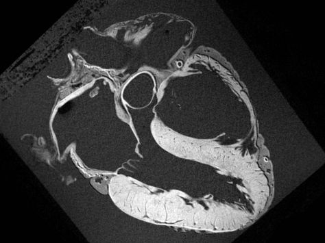 G : ' heart mri scan' Heart Scan, Heart Anatomy, Mri Scan, Digital Portrait Art, Heart Images, Body Anatomy, Human Heart, Radiology, Anatomy Art