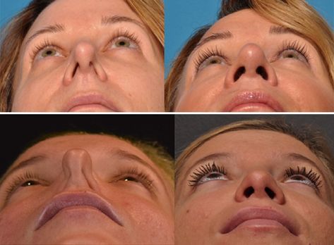 Is Your Nose Bent Out Of Shape? Maybe It's A Deviated Nasal Septum - Pacific Neuroscience Institute Deviated Nasal Septum, Nasal Obstruction, Human Anatomy Reference, Nasal Septum, Deep Brain Stimulation, Facial Nerve, Spine Health, 80 Percent, Facial Plastic