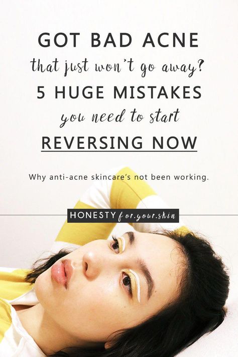 Get Rid Of Spots, Skincare Routine Acne, Skincare Mistakes, Blind Pimple, Pimples Under The Skin, Acne Prone Skin Care, Bad Acne, Prevent Pimples, Acne Help