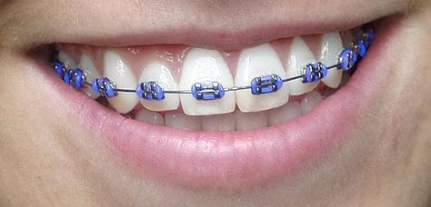 Purple Braces, Braces Transformation, Dental Braces Colors, Invisible Teeth Braces, Braces Colors Combinations, Braces Bands, Cute Braces Colors, Types Of Braces, Kids Braces