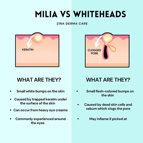 Ever wonder what those pesky little white bumps on your skin are? 🤔 Let’s break it down! 👇🏼 𝐌𝐢𝐥𝐢𝐚: • Tiny, white bumps that pop up when keratin (a protein) gets trapped under your skin. • They LOVE to show up after you slather on heavy eye creams! 🧴 • Favorite hangout spot? Right around your eyes 👁️ 𝐖𝐡𝐢𝐭𝐞𝐡𝐞𝐚𝐝𝐬: • Small, flesh-colored bumps caused by dead skin cells and oil clogging your pores. • They might get all red and inflamed if you pick at them—so hands off! ✋🏼🛑 🎤 Who wins? Ne... White Bumps On Face, What Causes Pimples, Pimple Solution, Pimple Causes, Clear Skin Routine, Hangout Spot, Acne Help, Face Care Routine, Simple Skincare Routine