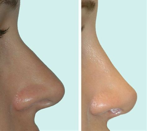 Nose Plastic Surgery, Nose Surgery Rhinoplasty, Nose Fillers, Rhinoplasty Nose Jobs, Rhinoplasty Before And After, Job Inspiration, Pretty Nose, Perfect Nose, Facial Fillers