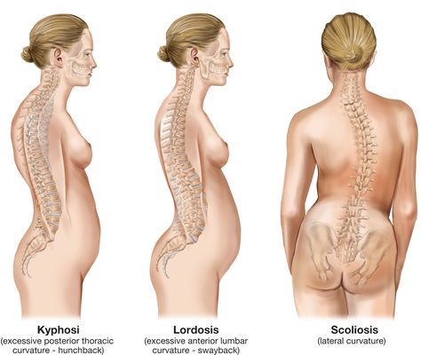 kyphosi, lordosis and scoliosis. There are three main types of spine curvature disorders, including:    Lordosis. Also called swayback, the spine of a person with lordosis curves significantly inward at the lower back.  Kyphosis. Kyphosis is characterized by an abnormally rounded upper back (more than 50 degrees of curvature).  Scoliosis. A person with scoliosis has a sideways curve to their spine. The curve is often S-shaped or C-shaped. Lower Belly Pooch, Middle Back Pain, Pilates Moves, Belly Pooch, Hamstring Stretch, Lower Belly, Best Stretches, Good Stretches, Chiropractic