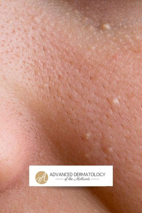 Skin Bumps On Face, White Bumps On Skin, White Bumps On Face, Bumps On Face, Skin Bumps, Holistic Health Remedies, Brown Spots Removal, Skin Spots, Spots On Face