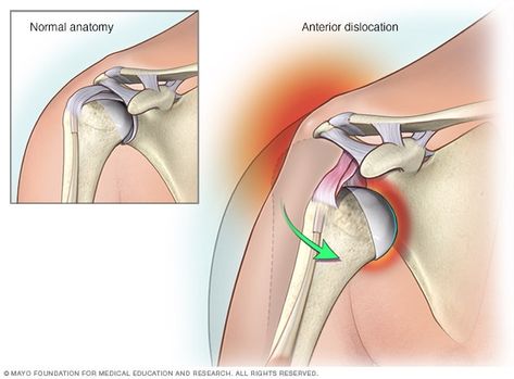 Shoulder Replacement Surgery, Shoulder Anatomy, Shoulder Dislocation, Arm Bones, Dog Spa, Ligaments And Tendons, Presents For Boys, Shoulder Injuries, Rotator Cuff