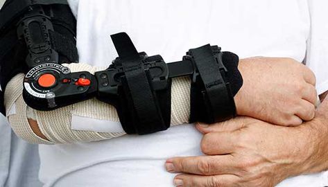 Open reduction and internal fixation (ORIF) is a type of surgery used to stabilize and heal a broken bone. You might need this procedure to treat your broken elbow. Broken Elbow, Elbow Surgery, Types Of Fractures, Vitamin D Supplements, Hip Fracture, Elbow Pain, Bone Fracture, Types Of Surgery, Vitamin D Supplement