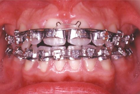 Fully banded orthodontic braces used in the 1960s-1970s and early 1960s. Every tooth was wrapped with a steel and te bracket attached to the band. The bands require room between every tooth so rubber spacers were force between each tooth to create the gap. In a few days the teeth moved apart but it was very painful. Fitting the bands and other gear was a long process, usually at least two four hour appointment were required. Silver Braces Bands, Braces Black Bands, Braces Problems, Disney Gel Nails, Braces Memes Funny, Plastic Bibs, Adult Braces, Brace Teeth Meme, Female Dentist